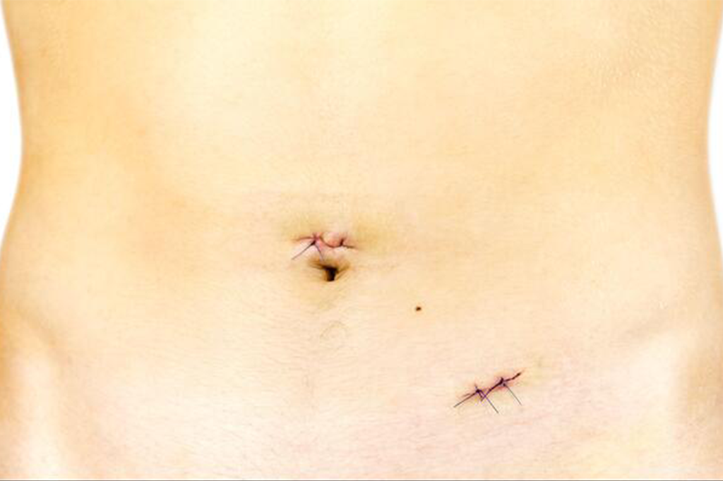 When to Approach a Doctor for Hernia