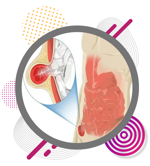 advanced-hernia-care-in-chennai