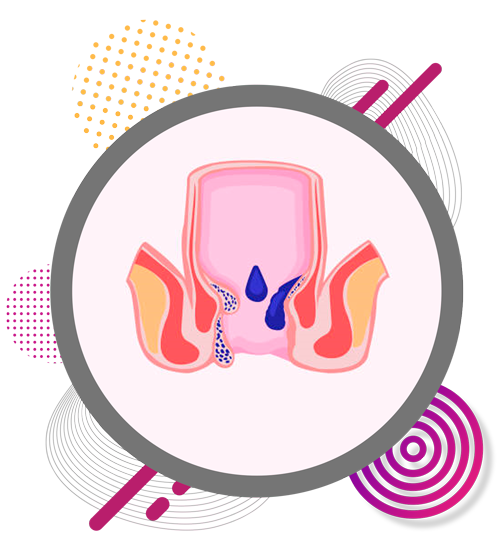 piles-care-in-chennai