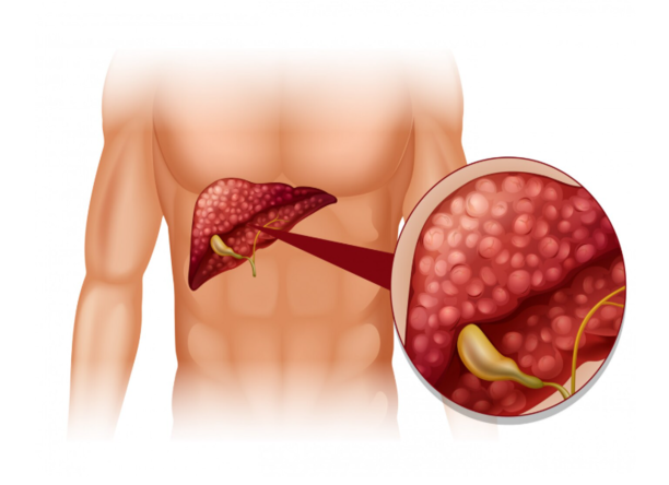 7 Early Warning Signs of Pancreatic Trouble 